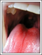 Canker In Throat